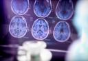Scientists say they have identified a new genetic form of Alzheimer’s disease (Felipe Caparros Cruz/Alamy/PA)